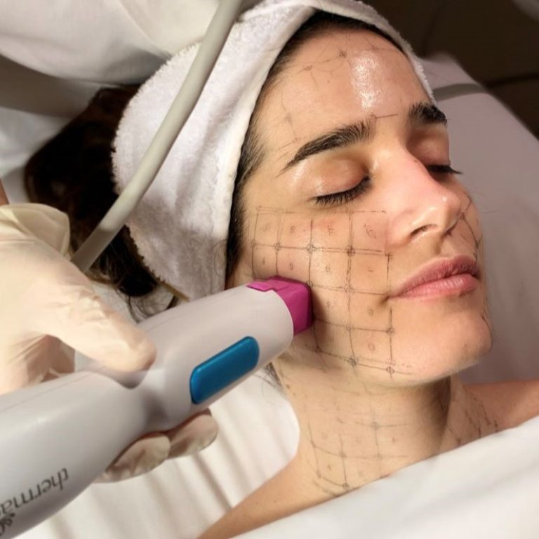 Thermage FLX, tratamiento estético.