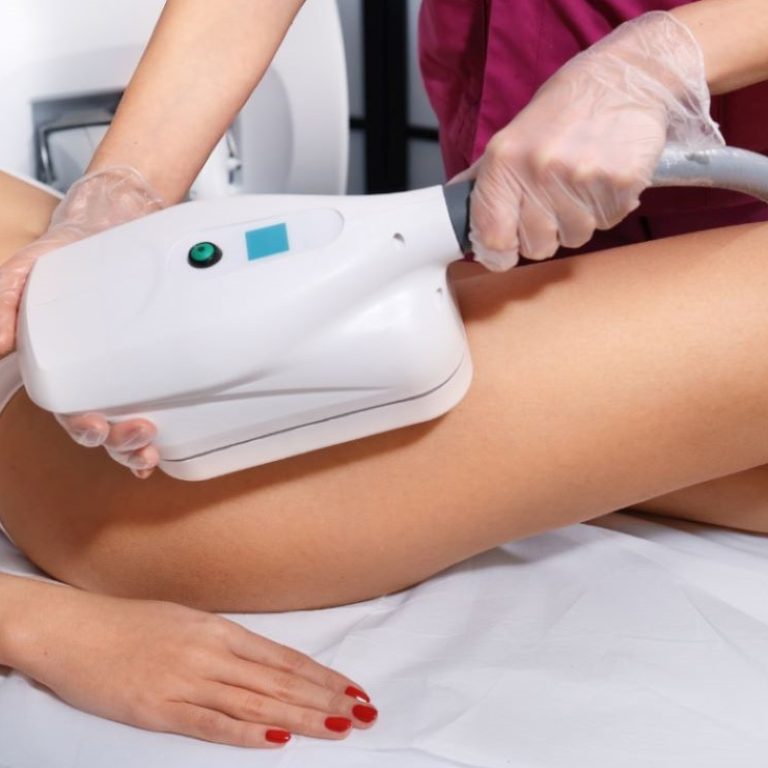 Coolsculpting®: Tratamiento estético reductor sin cirugia en México